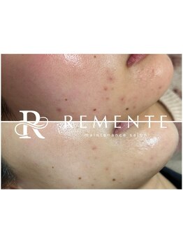 シャルム(CHARMER)/くすみ改善、ニキビ改善、毛穴