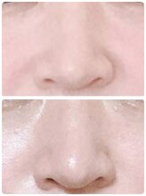 ビューティフルムーン(Beautiful Moon)/小鼻縮小♪