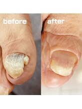 コトリ(Kotori)/【肥厚・変形爪リスタートケア】