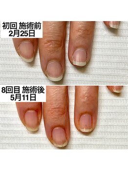 ベッレ マーニ/爪育成