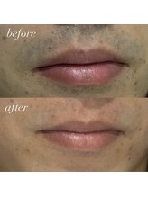 エースビューティー(Ace.Beauty)/ヒゲ脱毛