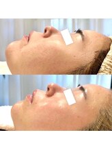 ビタザボナ(Vita the Bona)/幹細胞エクソソーム-Lit-