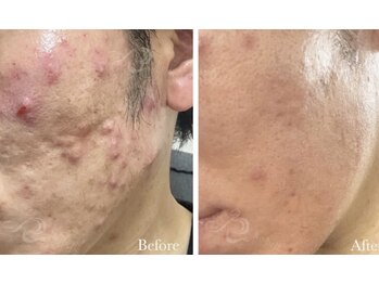 リッチ(Rich)の写真/男のニキビ卒業！本気の確かな肌質改善フェイシャル