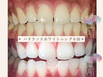 ビーモア(be more)の写真/【圧倒的効果♪】医療提携ホワイトニング★嬉しい効果を速攻実感！想像以上の白さに感動◎