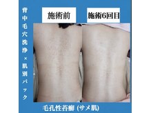シェリー(Cheri)の雰囲気（背中は毛穴洗浄やハーブピーリングと肌別パックで肌ケア♪）