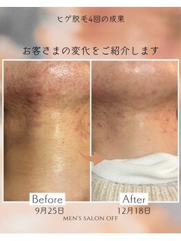 オフ(off)/ヒゲ脱毛