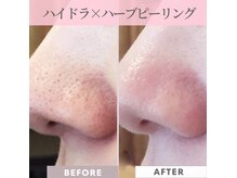 ヴァリークルー(vary clue)の雰囲気（つるんと徹底毛穴ケア☆ハイドラフェイシャル&ハーブピーリング）
