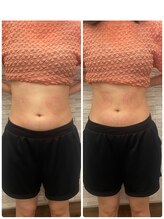 長寿鍼灸院 長寿整骨院/EMS＜お腹集中コース＞