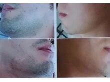 チャンス(CHANCE)の雰囲気(男性の濃い髭,青髭もここまで変われる♪痛みが少ないのも嬉しい!)