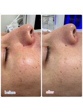 ベラピエル(BELLA Piel)/シミくすみ改善