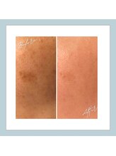 ラシュレ(BEAUTY CONCIERGE RASSURER)/シミ、しわ、たるみにもND-R！