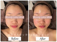 リノ(Lino)/リリースカッター×水光ジェット