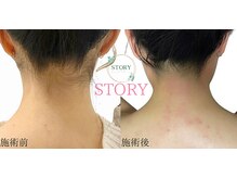 ストーリー(STORY)/眉毛と艶肌ワックス専門店