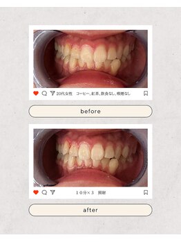 スマイルプライベートビューティサロン(Smile)/セルフホワイトニング