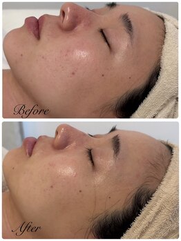 アミリー(A'mily)/ハーブピーリングBeforeAfter
