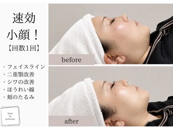 サロン ド パーフェクション(Salon de Perfection)/小顔リフト
