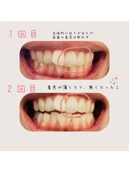 クラップ(CLAP)/セルフホワイトニング