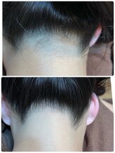 ノノ(nono)/えりあし脱毛！