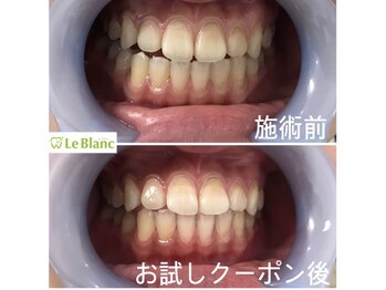 ルブラン 奈良店(Le Blanc)/歯石取りも定期的に