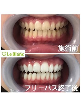 ルブラン 奈良店(Le Blanc)/完璧な歯!!