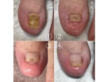 ユメネイル(YUME NAIL)の雰囲気（何十年も悩んだ 巻き爪、肥厚爪も見た目も綺麗な施術で解放◎）