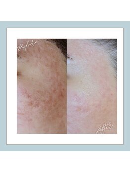 ラシュレ(BEAUTY CONCIERGE RASSURER)/ニキビ、赤み、凸凹にND-R！