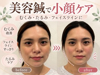 ソラナ(Solana)の写真/美容鍼灸でリフトアップ、憧れの小顔に！頭にも鍼をすることで眼精疲労や不眠のケアとしてもおすすめ♪