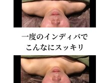 スマイルミーの雰囲気（芸能人も通うインディバで小顔に。術後でなくても効果大！）