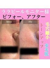 フルブルーム(Full Bloom)/モニター様　ララピール　5回