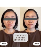 ウーマンビーヘルス(woman Be Health)/お試し美容鍼灸60分