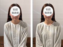 トイ鍼灸接骨院(TOY鍼灸接骨院)/●美容鍼灸