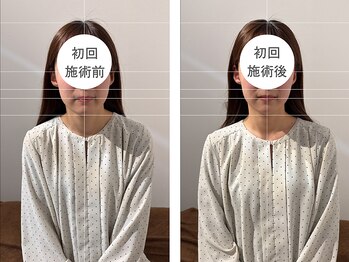 トイ鍼灸接骨院(TOY鍼灸接骨院)/●美容鍼灸