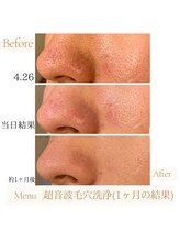 ラシュレ(BEAUTY CONCIERGE RASSURER)/頑固な毛穴詰まりもスッキリ◎