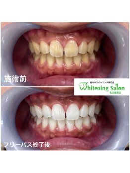 ホワイトニングサロン 名古屋駅店/【ホワイトニング施術例】