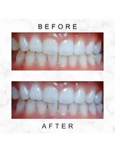 エミリアホワイトニング(EMIRIA WHITENING)/Before/After