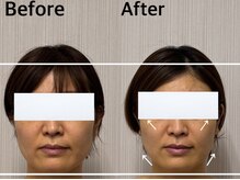 ベール(BEHL)/コルギのBefore After