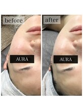 アウラ(AURA)/ダクトピール before/after