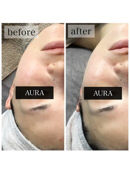 アウラ(AURA)/ダクトピール before/after