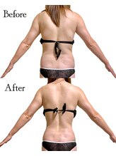 ロイヤルキューティー アンド 介正アップ美容整体院 博多店(ROYAL QT)/ハイパーナイフ90分