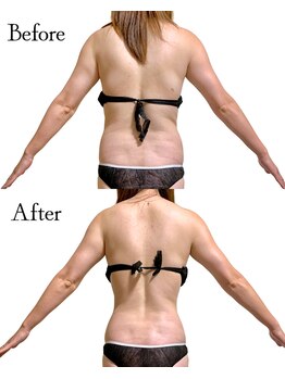 ロイヤルキューティー アンド 介正アップ美容整体院 博多店(ROYAL QT)/ハイパーナイフ90分