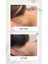 セルフダック 滋賀守山店(SELFDUCK)/うなじ脱毛ビフォーアフター