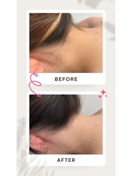 セルフダック 滋賀守山店(SELFDUCK)/うなじ脱毛ビフォーアフター