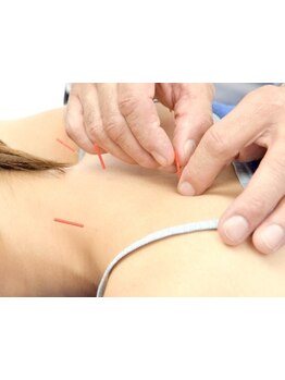 鍼灸施術を受けたい