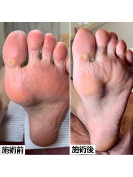 ベッレ マーニ/足裏角質ケア