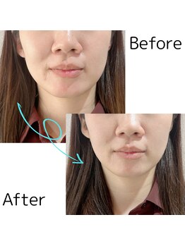 アンシュシュ(UNCHOUCHOU)/光フェイシャル「クイックケア」