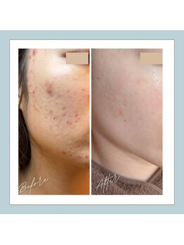 ラシュレ(BEAUTY CONCIERGE RASSURER)/ニキビ、赤み、凸凹にND-R！