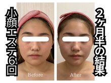 少ない回数で小顔者続出!最短で卒業エステ!同時に肌管理メニュ◎