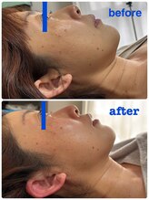 ナナラ(NANALA)/脂肪分解！小顔！！REDショット