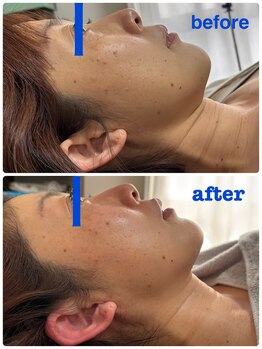 ナナラ(NANALA)/脂肪分解！小顔！！REDショット