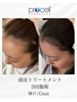 ユミト(Umit)/プロセルスカルプ